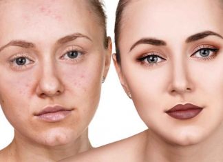Acnee si cosuri sub piele – cum se formeaza si ce produse cosmetice sunt recomandate?