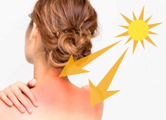 Cel mai surprinzator remediu pentru ameliorarea arsurilor solare